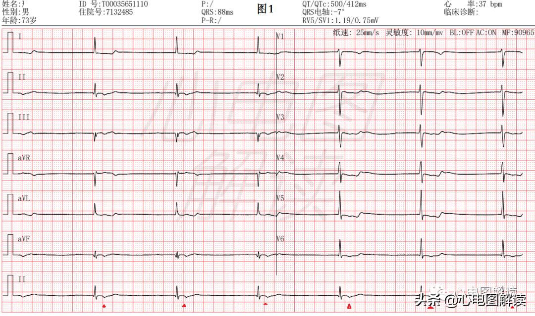 慢交界性心律,房室分离为什么心室率大于心房