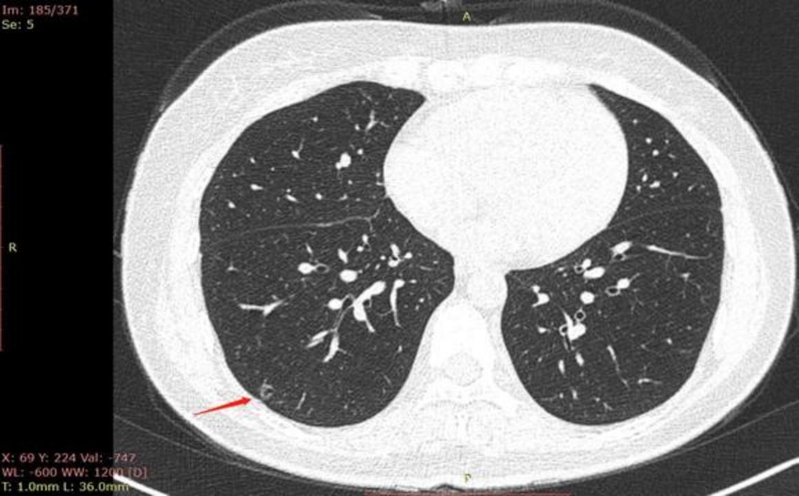 磨玻璃结节9*8mm建议随访,8mm磨玻璃结节一年没长