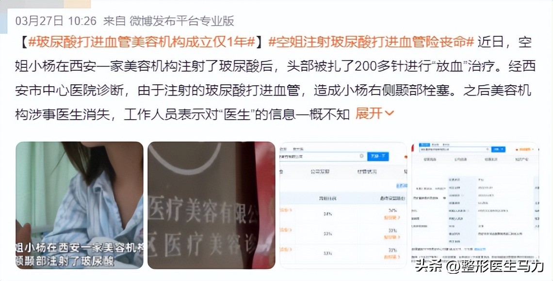 鼻基底玻尿酸栓塞后续治疗方法,鼻基底打玻尿酸栓塞后打溶解酶