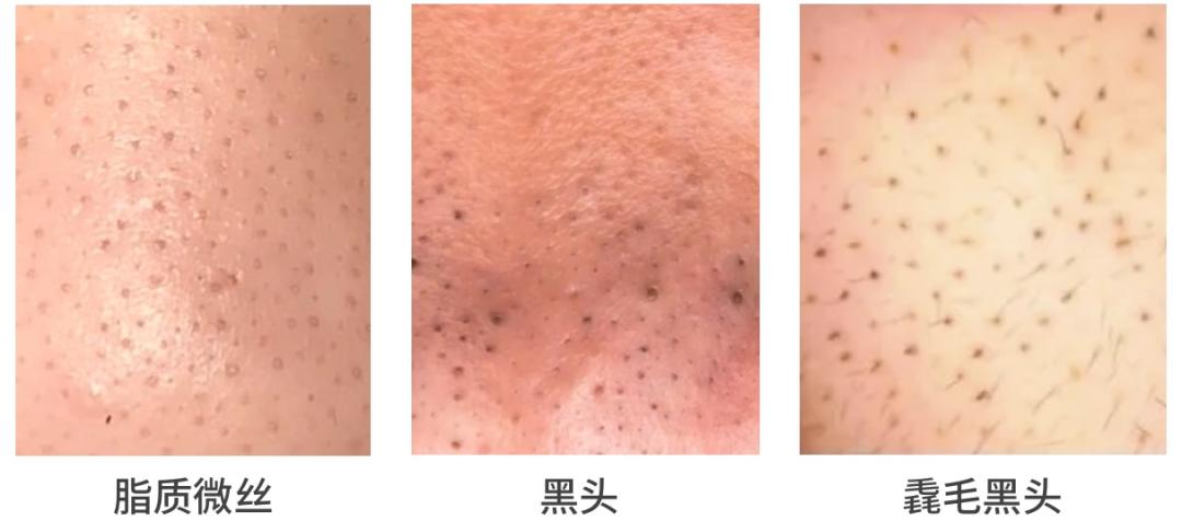 为什么黑头永远去不掉,黑头根本就去不掉