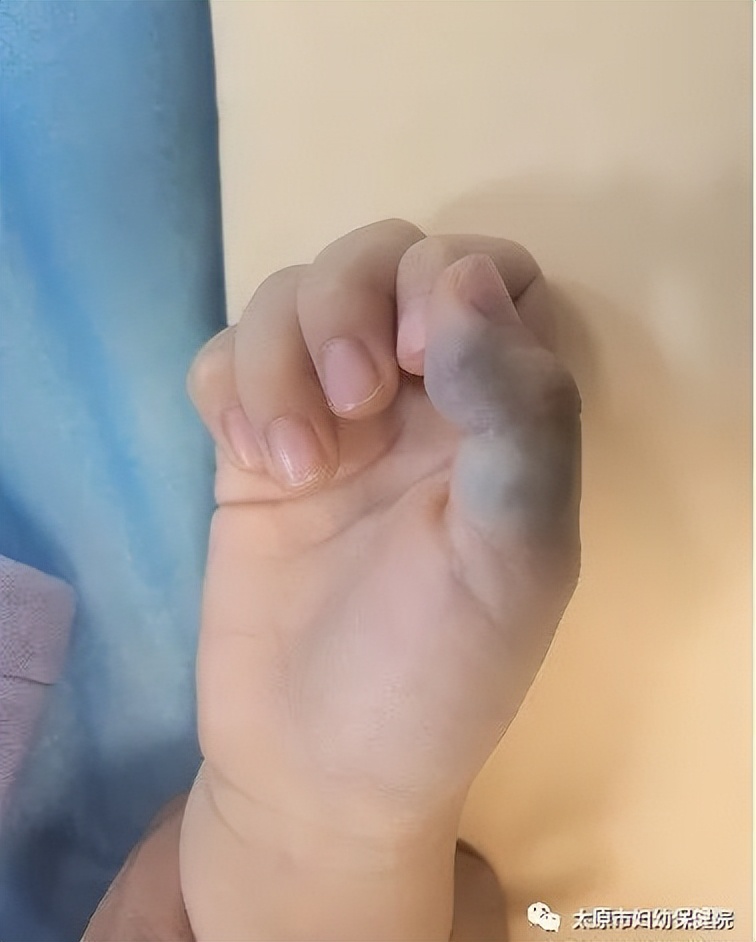 西安哪个医院治静脉畸形比较好,沈阳治疗静脉畸形