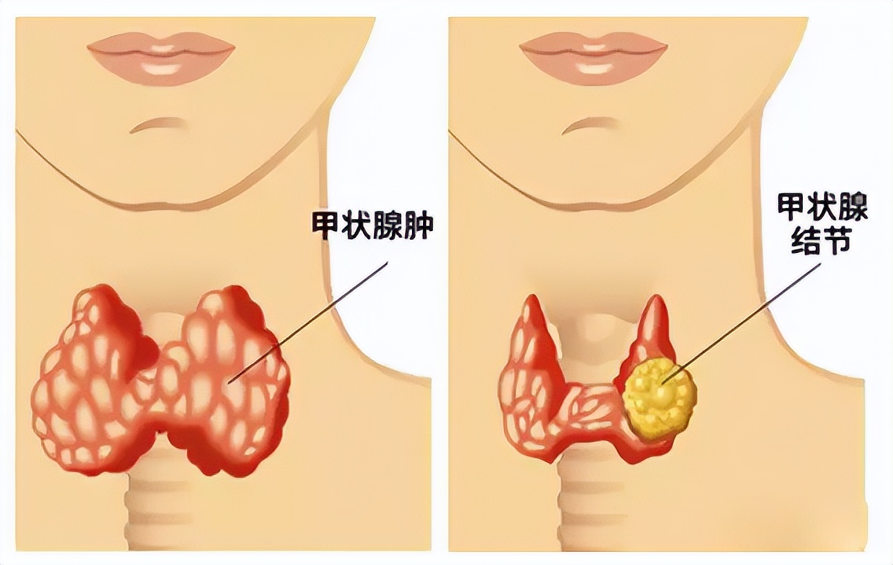 嗓子痰特别多吐不完吃什么效果好,嗓子总有痰粘着吐不干净小偏方