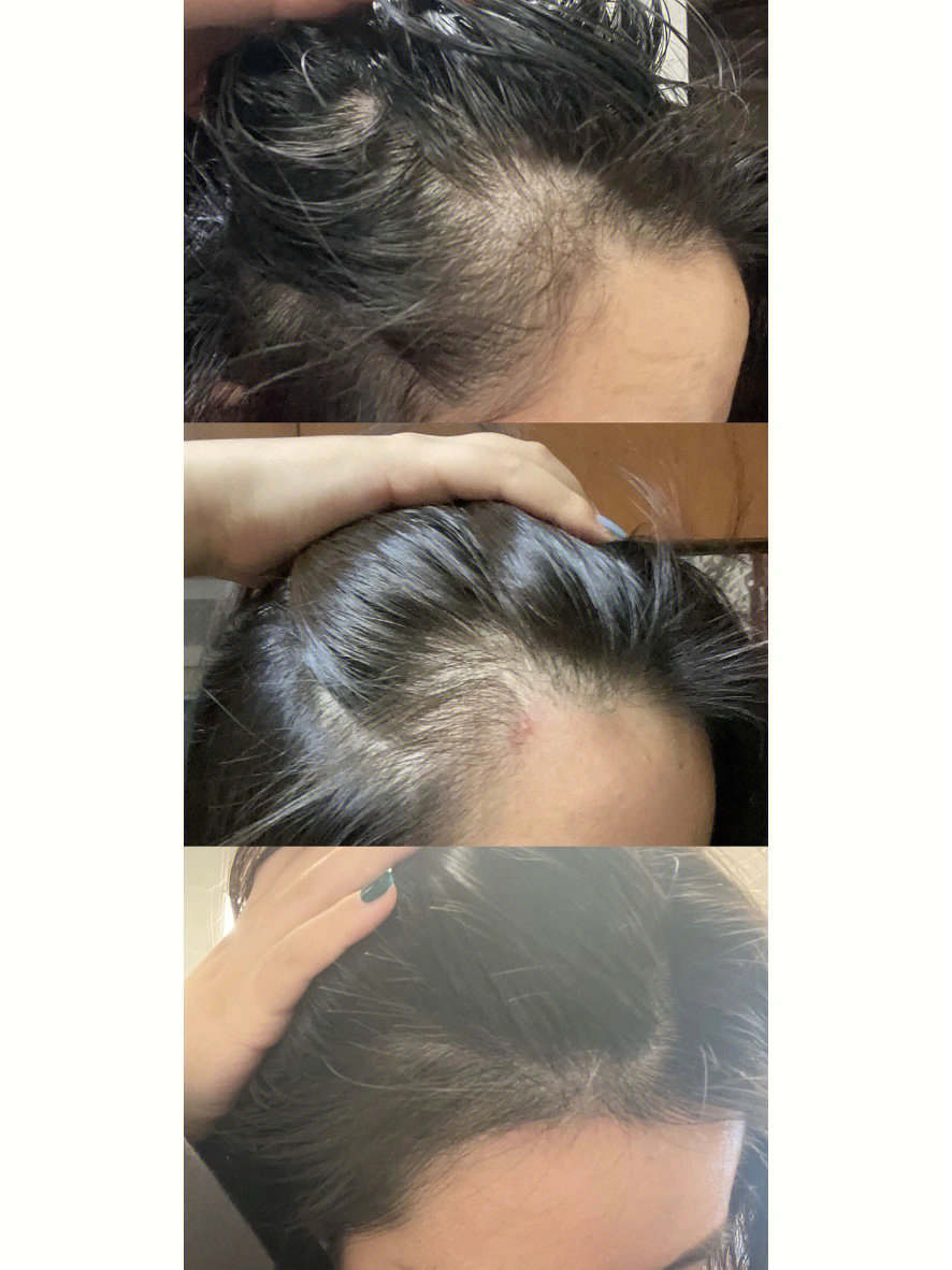 经常熬夜又脱发用什么洗发水好,治疗熬夜脱发洗发水男士