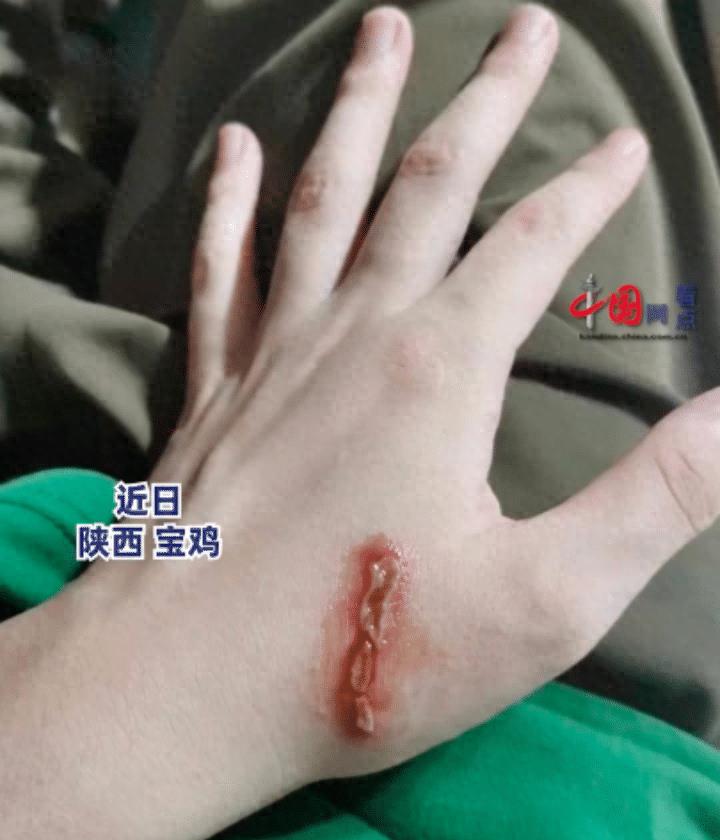 硫酸虫咬了怎么处理,硫酸虫导致皮肤损伤处理