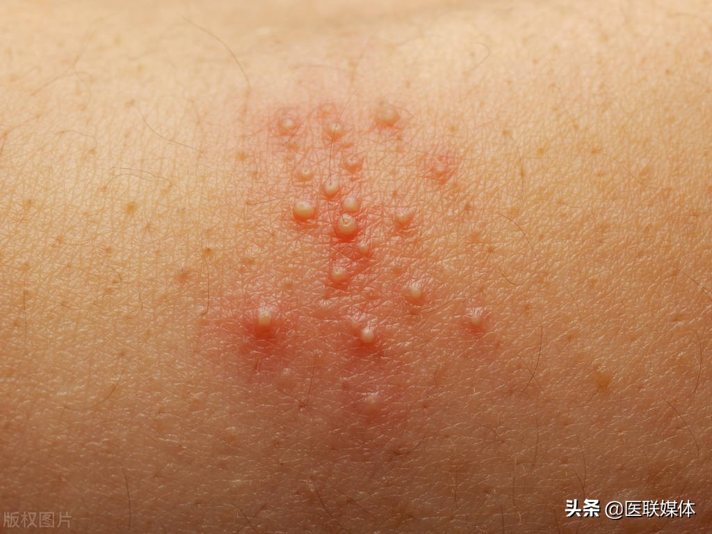 湿疹荨麻疹汗疱疹区别,湿疹荨麻疹皮肤瘙痒怎么治疗