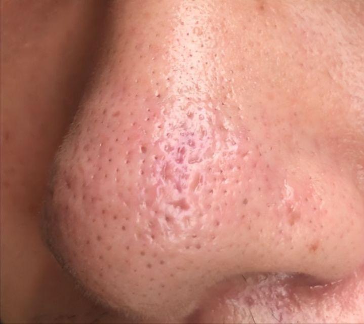 鼻子上有白白的小点可以挤吗,鼻子上黑黑的小点点怎么去除