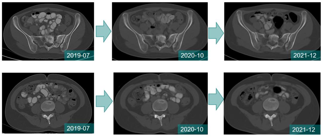 曲妥珠单抗副作用几天消失,曲妥珠单抗联合帕妥珠单抗