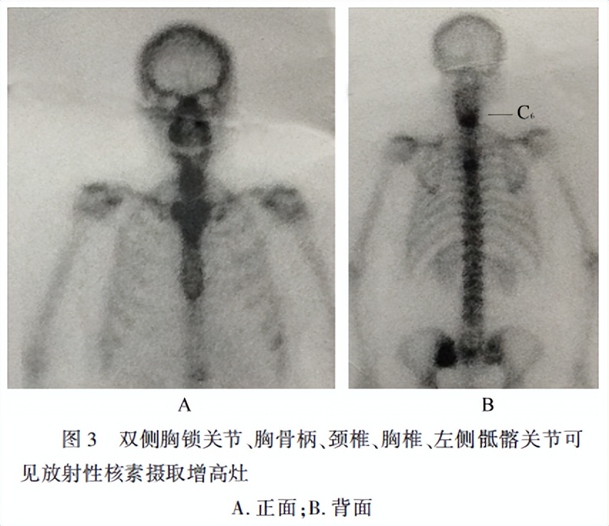 颈椎综合征的特征,颈椎综合征什么症状