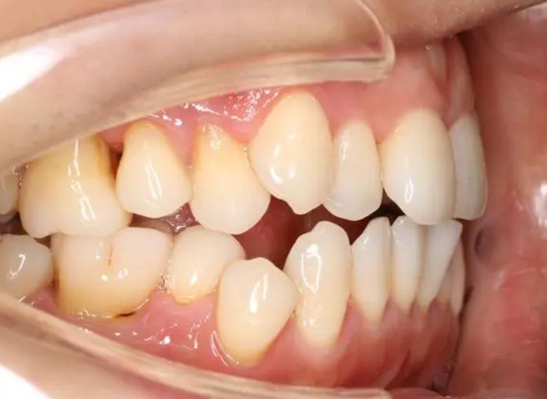 牙周病牙齿松动怎么治疗用什么药,牙周药物治疗的目的