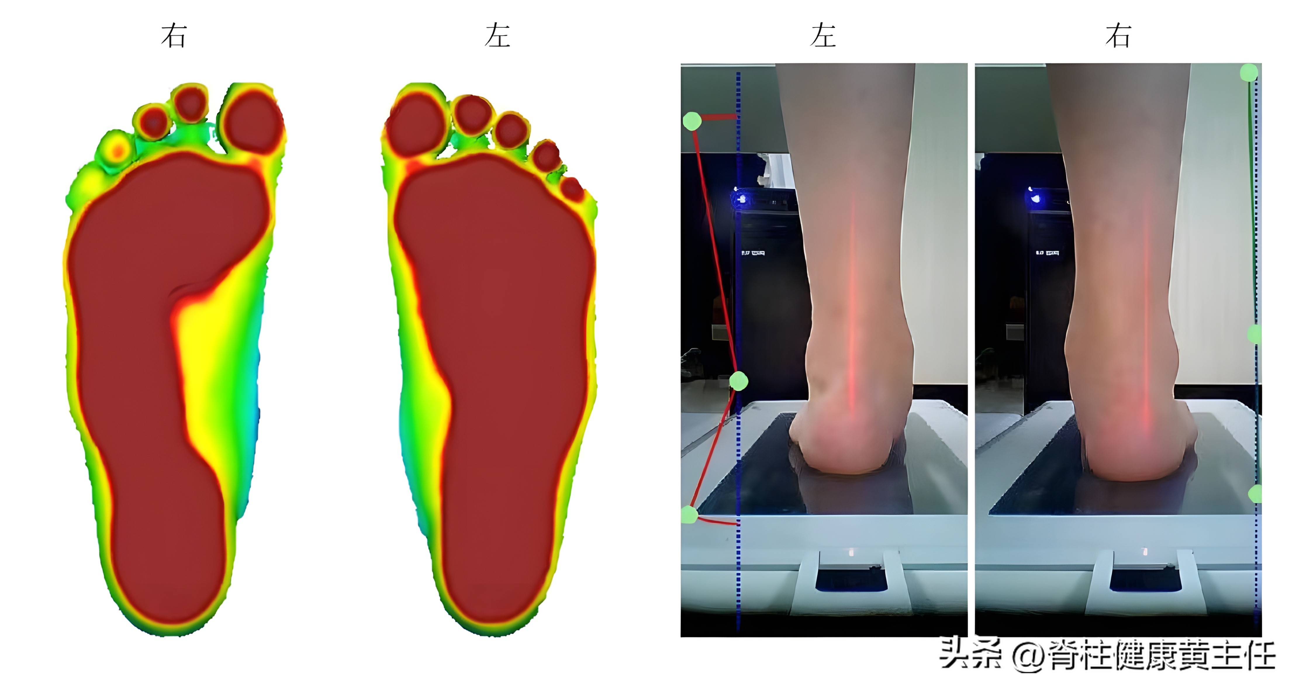 扁平足o型腿骨盆前倾高低肩,一只脚是扁平足怎么矫正