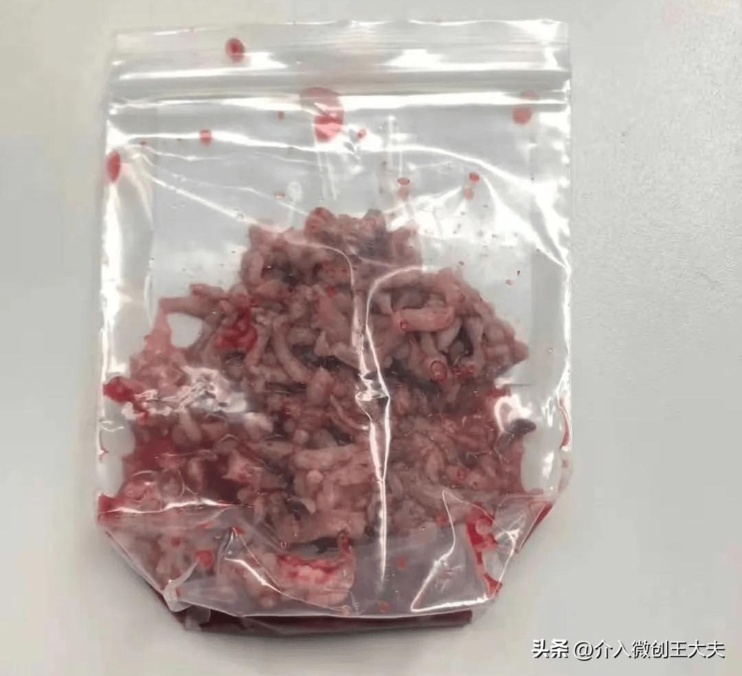 微创蒸汽消融治疗前列腺增生费用,前列腺增生微创手术前灌肠方法