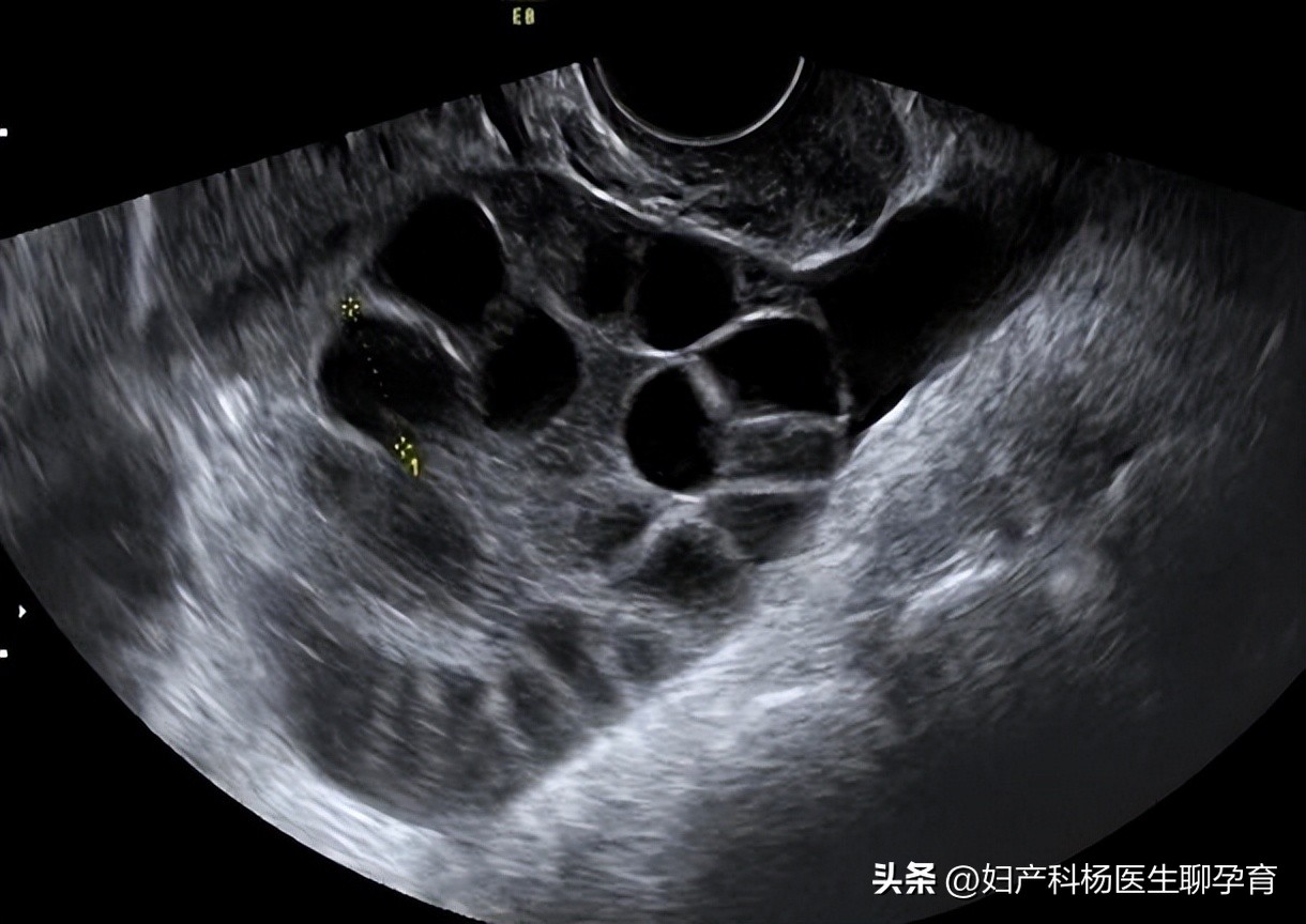 多囊卵巢会影响子宫内膜病变吗,多囊子宫内膜增生严重吗