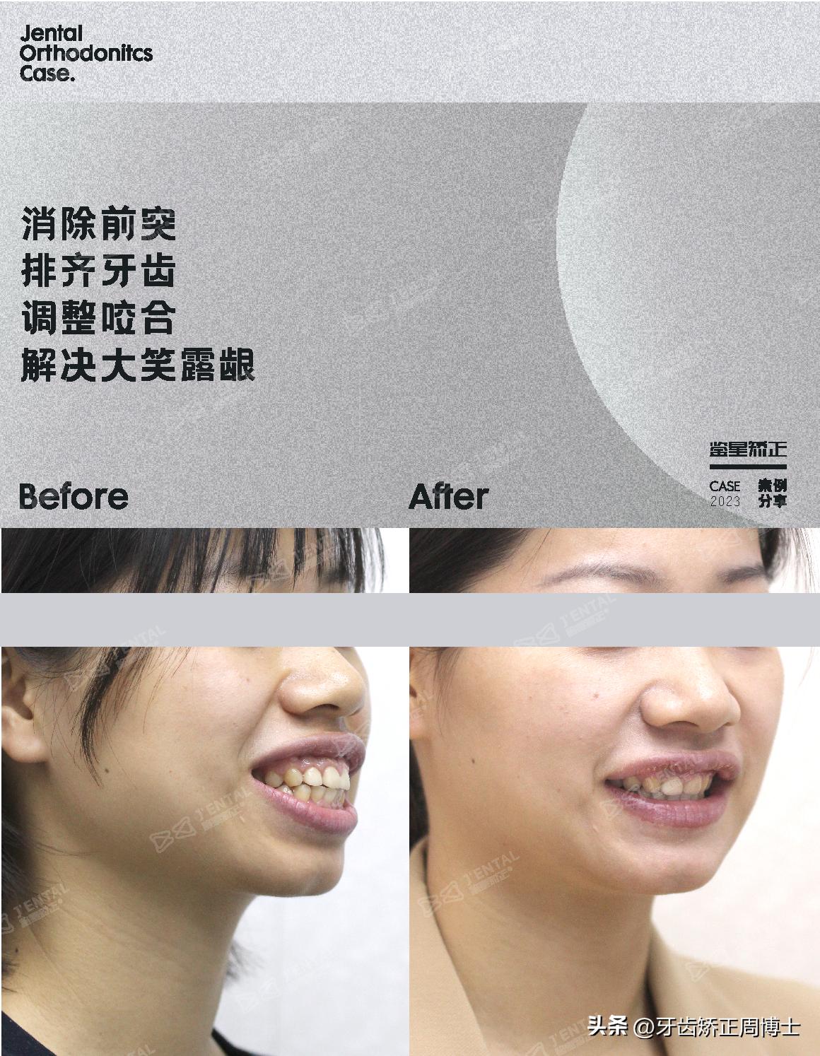 骨性上颌前凸嘴怎么矫正,厚嘴唇与嘴凸有关吗