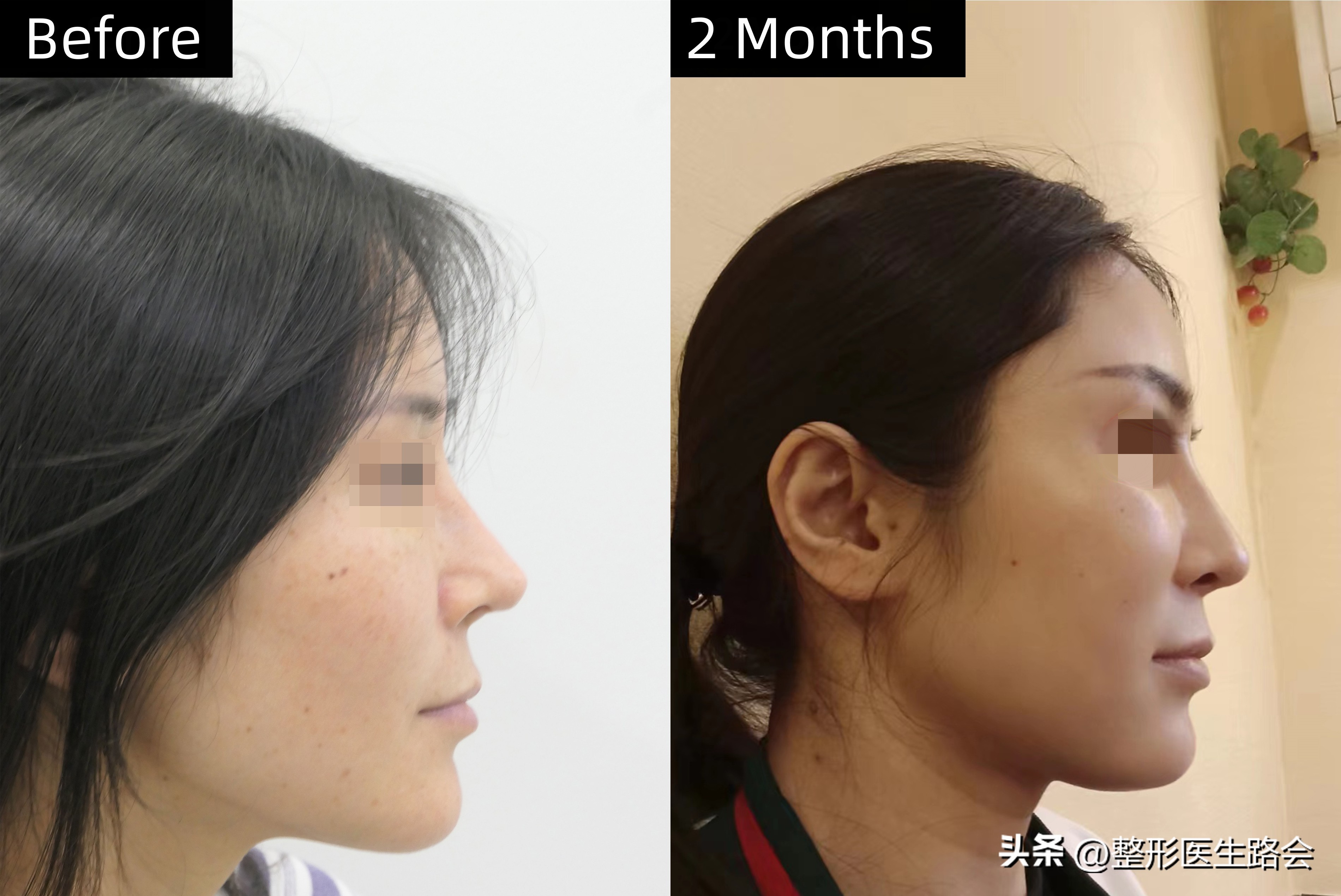 你对隆鼻整形有什么看法,鼻部整形大家最关心的话题