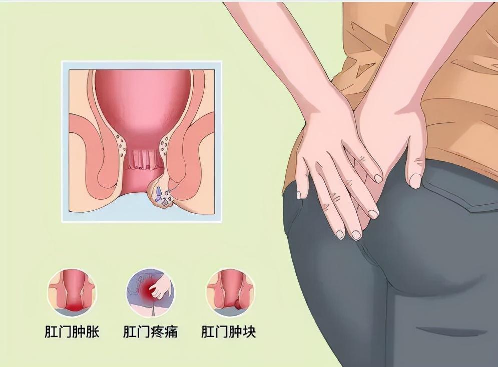 肛瘘手术没挂线是症状比较轻吗,肛瘘症状和痔疮症状有什么区别