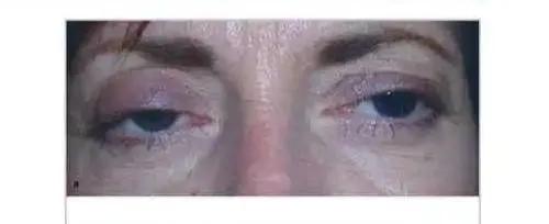 不明原因的眼皮耷拉下垂,可能是这个可怕的病