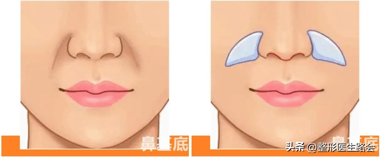 塌鼻子做什么样的鼻子安全,塌鼻子应该选择哪种隆鼻