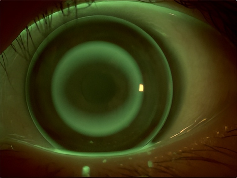 角膜接触镜验配案例图解,戴角膜塑形镜反复出现点染的原因