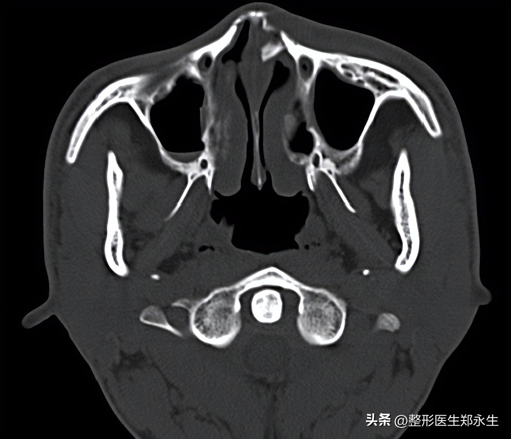 歪鼻整形,类型不同方法不同,看看自己的“歪鼻子”对照了解!