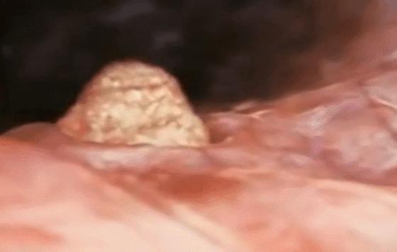 单角子宫囊胚移植几天后着床,移植未着床为什么感觉子宫发紧