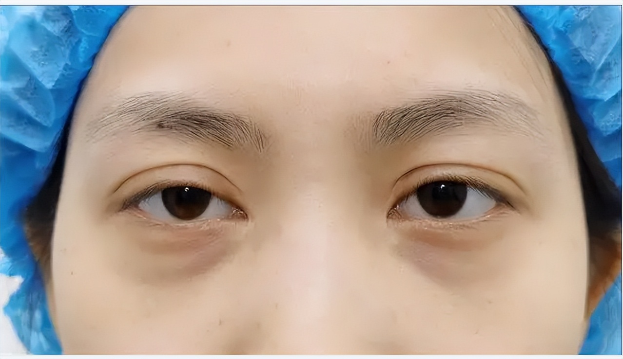 埋线双眼皮做的太宽了怎么办,双眼皮太宽怎么办怎么画眼妆