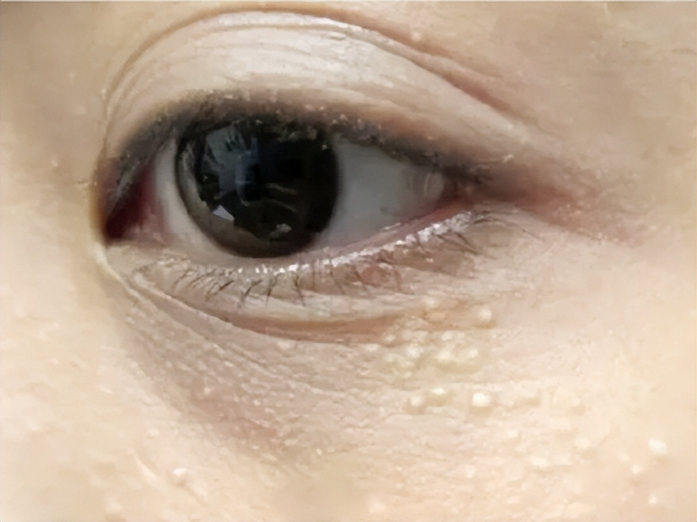 脂肪粒的形成原因及解决方法,长了脂肪粒要去看医生吗