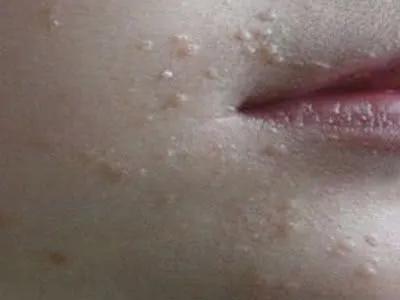 感染hpv之后身上会长什么东西,感染hpv后身上长出纤维瘤