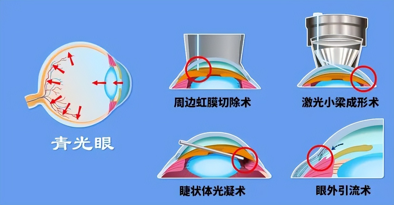 青光眼是怎么造成的,青光眼的症状和表现