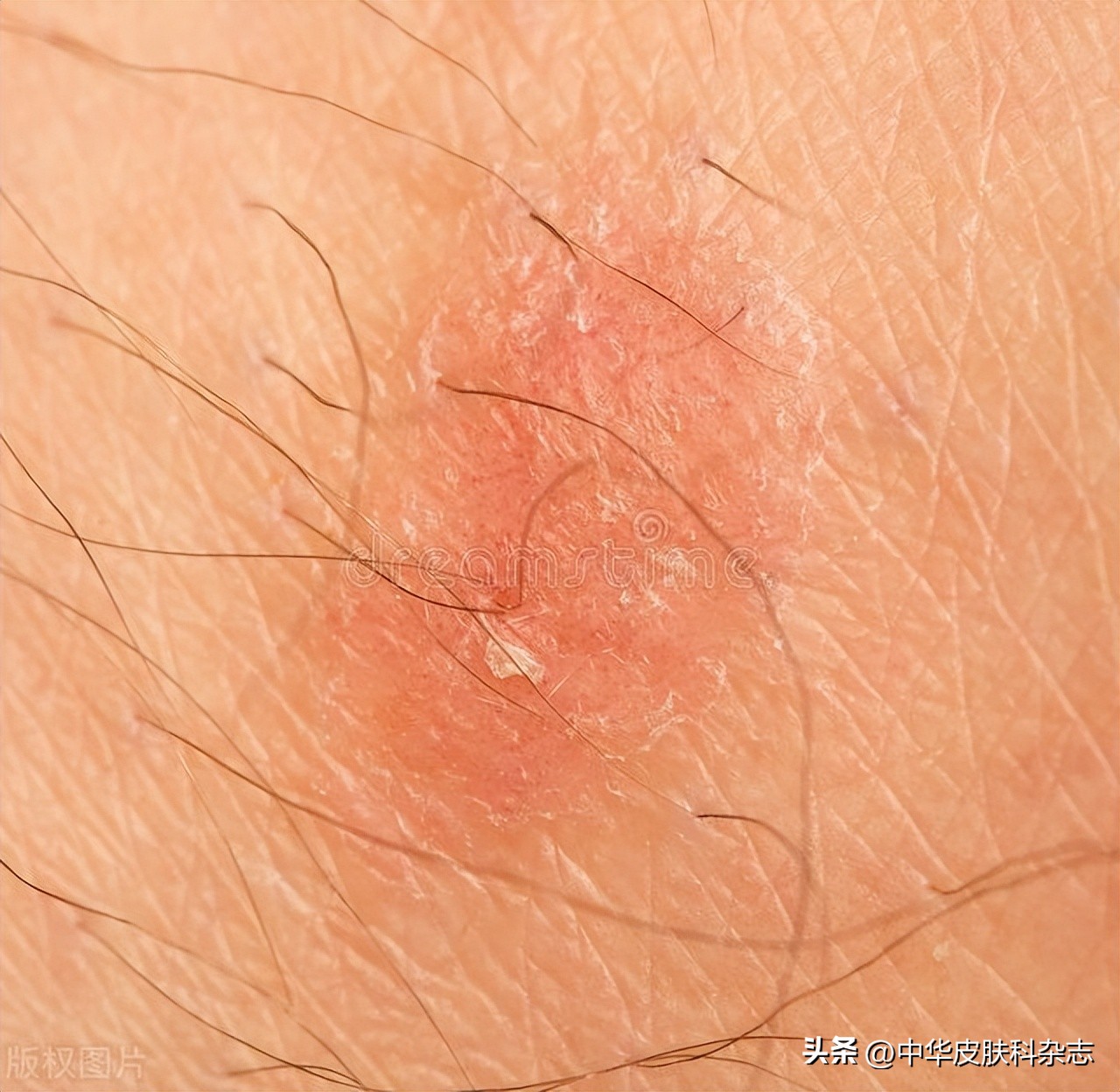 面部皮炎面部发红图片,面部皮炎图片是过敏吗