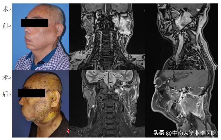 湘雅附二做腮腺瘤手术,湘雅医院颅底三叉神经鞘瘤