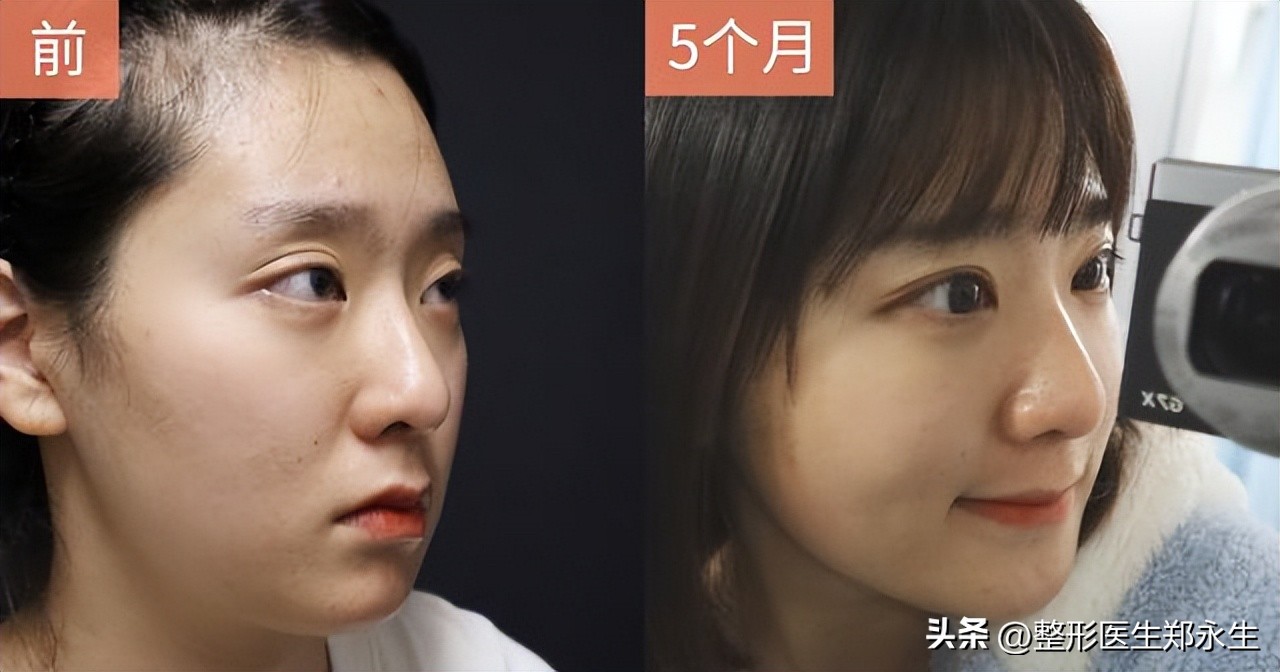 割双眼皮成了大小眼怎么办,双眼皮术后大小眼是什么原因