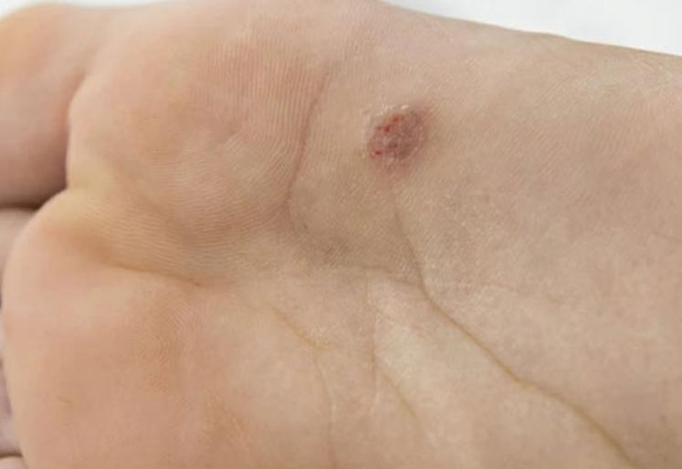 脚底板爱出汗怎么解决,脚底板爱出汗是什么原因造成的