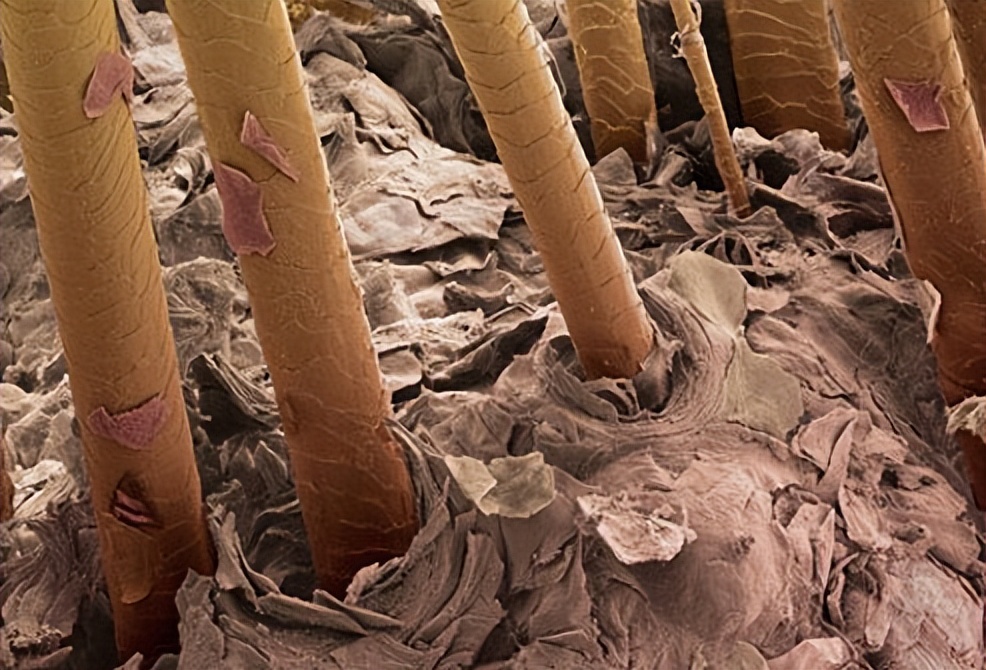 女性脱发的原因和治疗,女性雄激素性脱发的原因