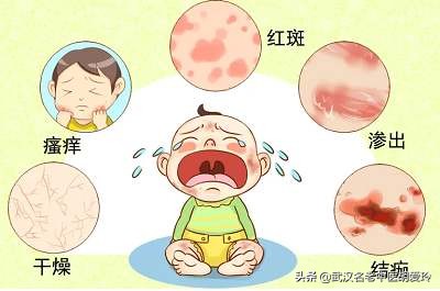 湿疹皮肤糜烂流黄水怎样治疗,湿疹糜烂渗出黄水有烧灼感怎么办