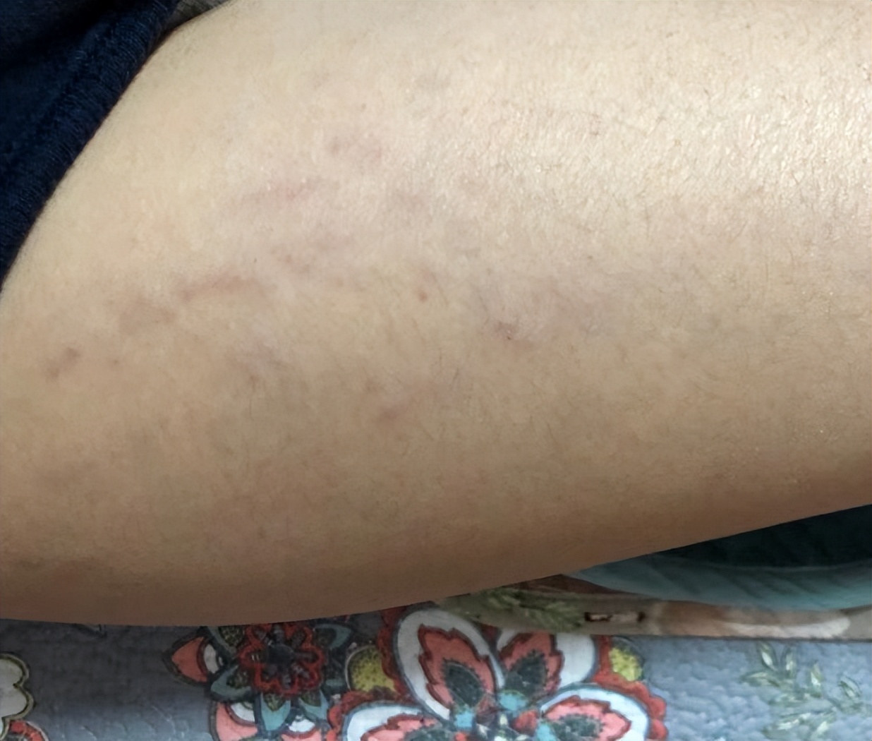 肥胖纹目前最好的去除办法,淡化肥胖纹修复肥胖纹