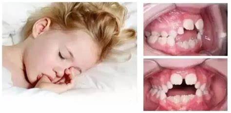 儿童习惯口呼吸怎么办,睡觉口呼吸的危害和治疗方法