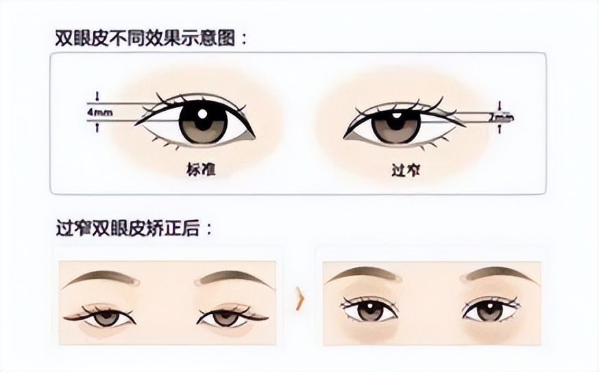 太原割双眼皮好的医院,双眼皮手术失败成内双