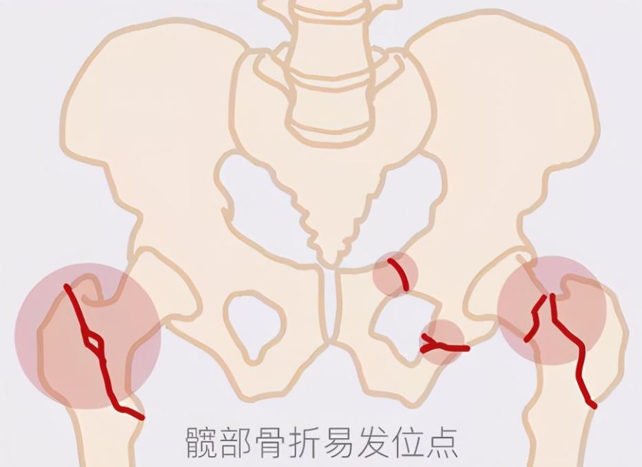 儿童骨密度检测中bmi正常范围,34岁骨密度检测说骨质疏松怎么办