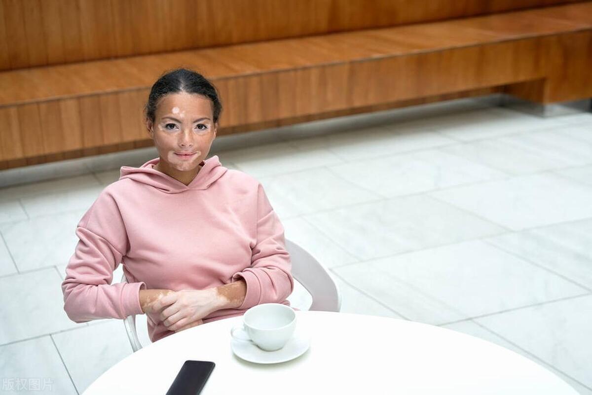 得了白癜风会感觉难受吗,得了白癜风对人有什么影响