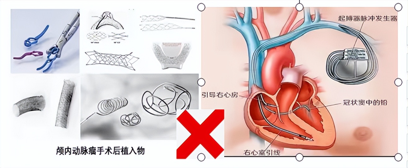 大肠癌科普知识,大肠癌最准确的筛查方法