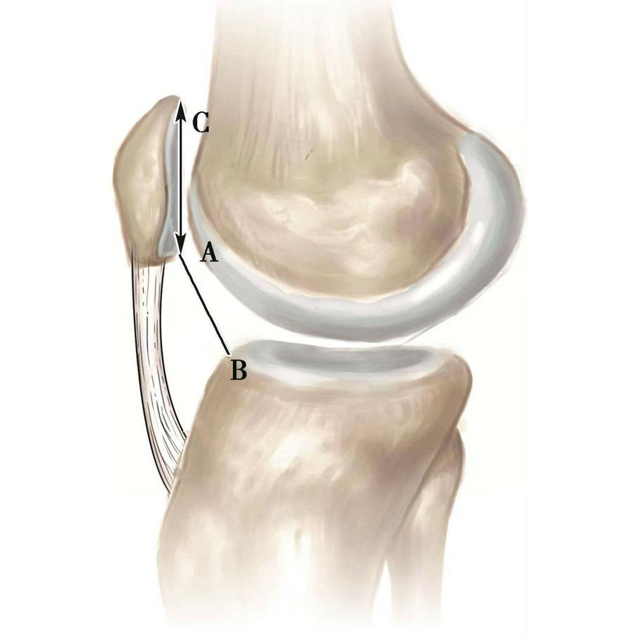 髌骨骨折评估,髌骨上下滑动评估什么内容