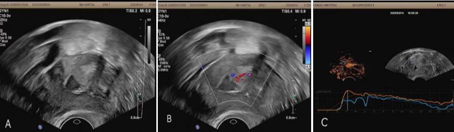 超声静脉造影剂注射操作视频,超声静脉自显影