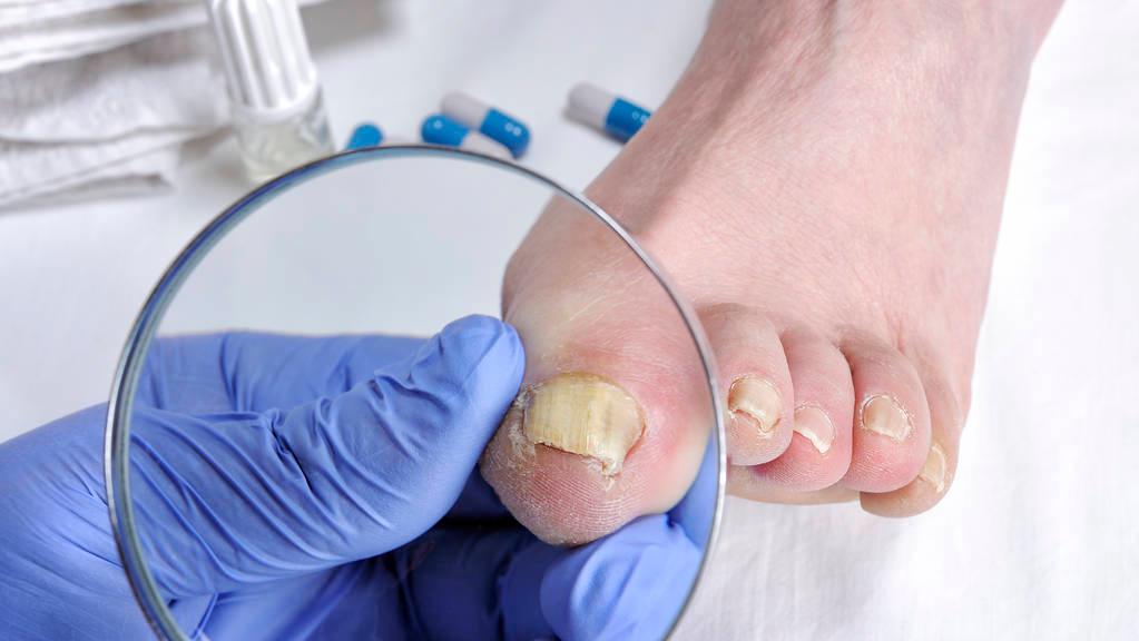 得了灰指甲一个传染俩咋办,得了灰指甲怎么避免一个传染俩