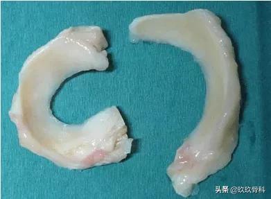 半月板损伤是否需要手术,外侧半月板损伤手术费用