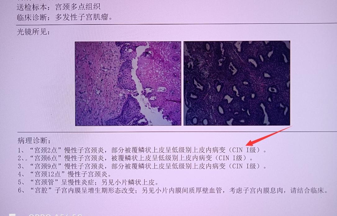 HPV感染和宫颈癌的预防与早期发现