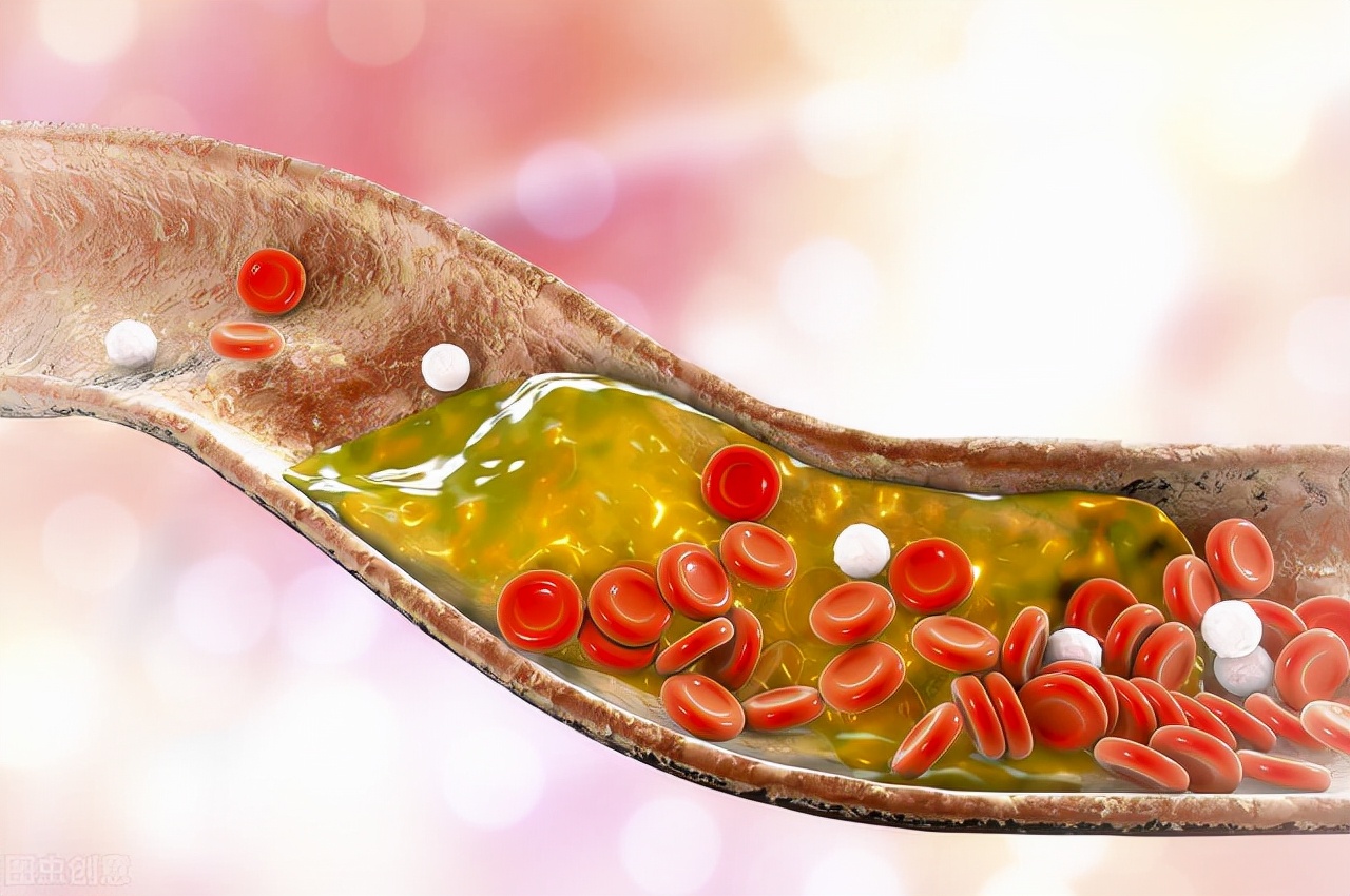 血管硬化5大禁忌,软化血管疏通血管吃什么药预防