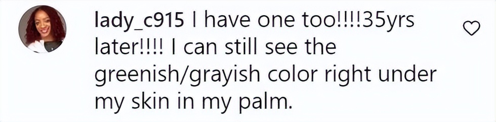 美国女子被橡皮子弹击中,女子手术取出戳20年铅笔芯