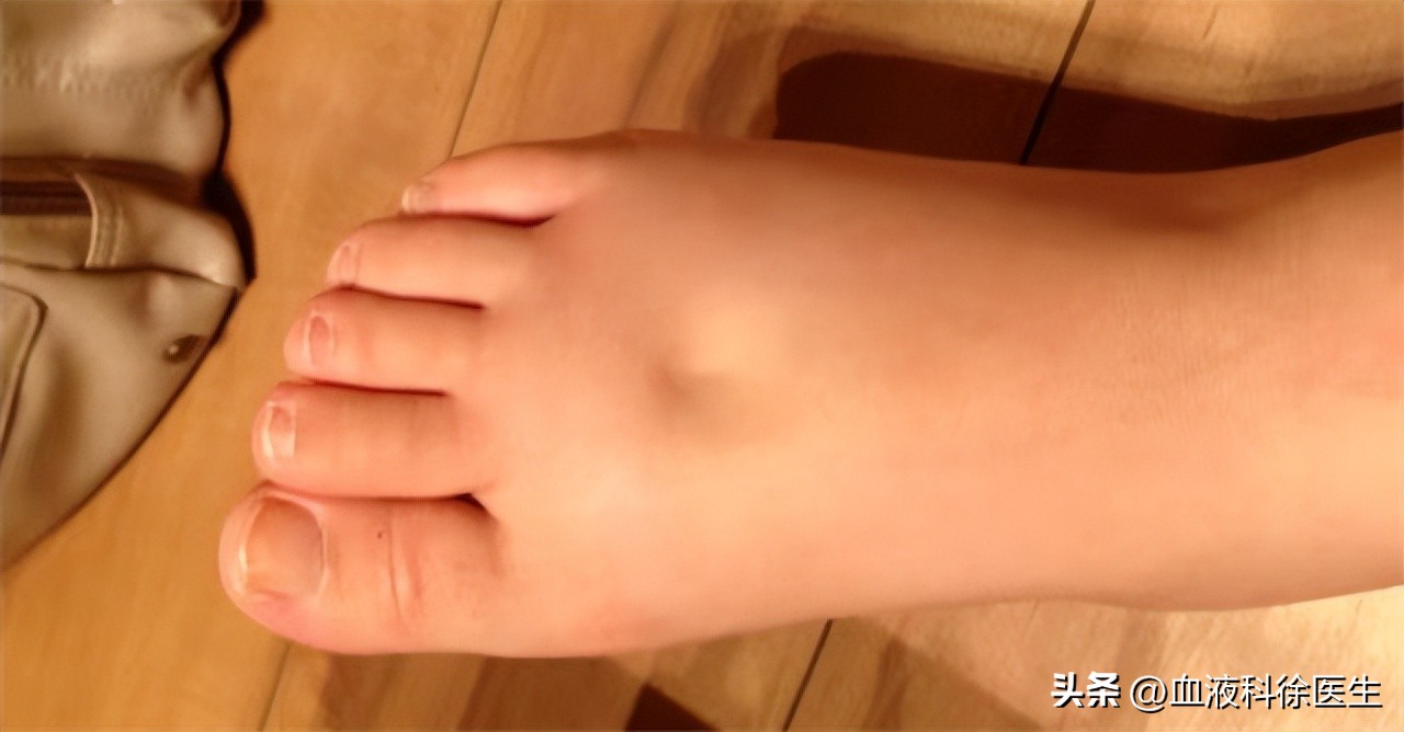 肾衰竭有这5个征兆不痛不痒,肾衰竭为什么就不排水了