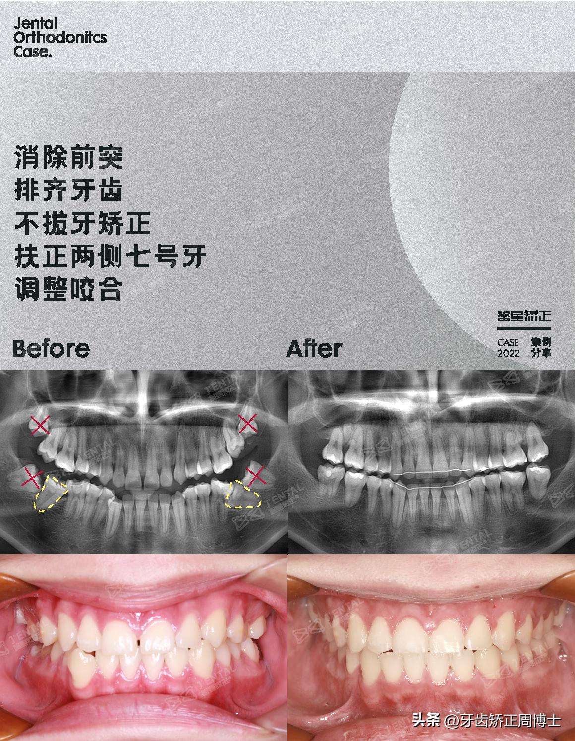 小孩牙齿为什么迟迟不长,孩子牙齿刚长出来不齐怎么办