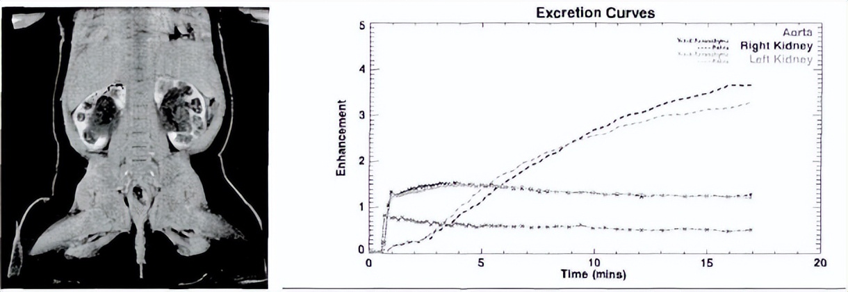 中医治疗宝宝肾积水输尿管狭窄,小儿肾积水和输尿管扩张怎么治疗